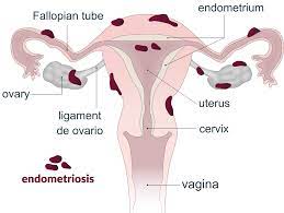 endometriosis nutrition